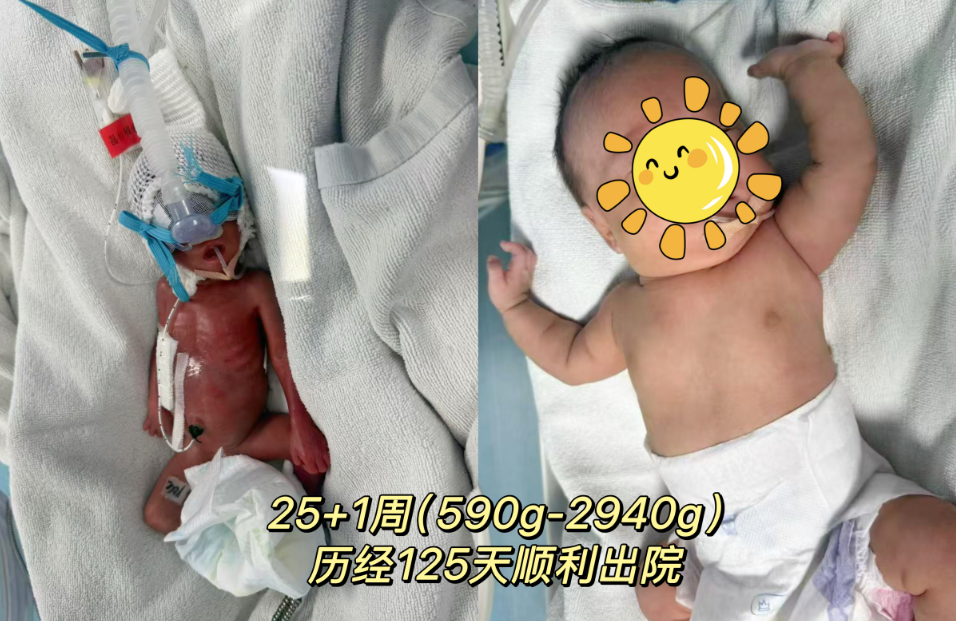 生命奇跡再刷新！懷化市婦幼保健院成功救治 25 周 出生體重僅590g的“掌心寶寶”